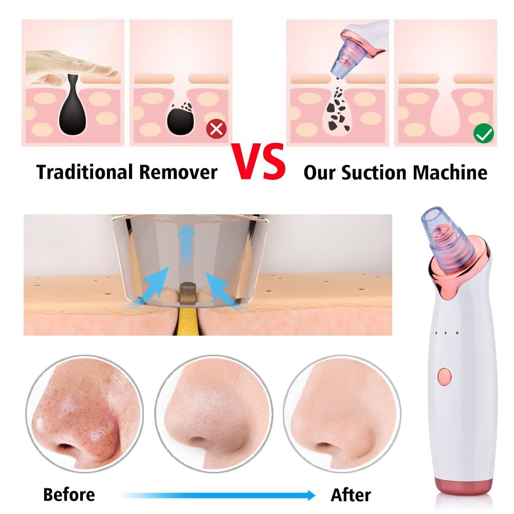 Blackhead Instrument Electric Suction Facial Washing Instrument Beauty Acne Cleaning Blackhead Suction Instrument - globaltradeleader