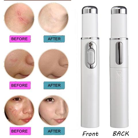 MOQ1 Wrinkle Blemish Pore Acne Scar Remover Pen